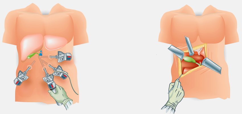 Imagem mostrando a diferença entre laparoscopia e cirurgia convencional